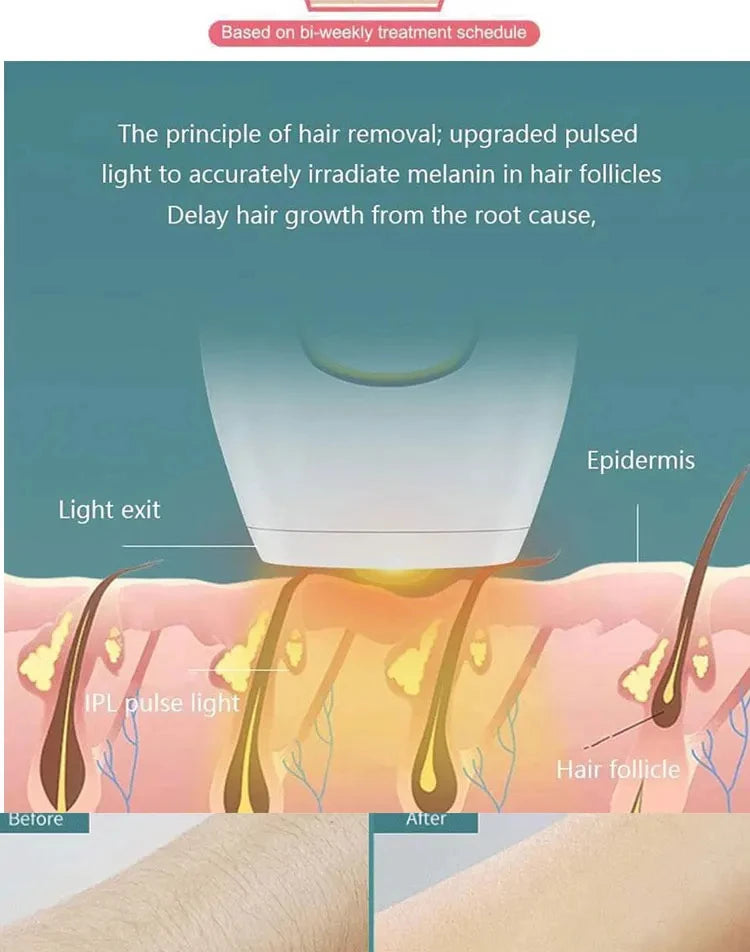 EPILATEUR LASER